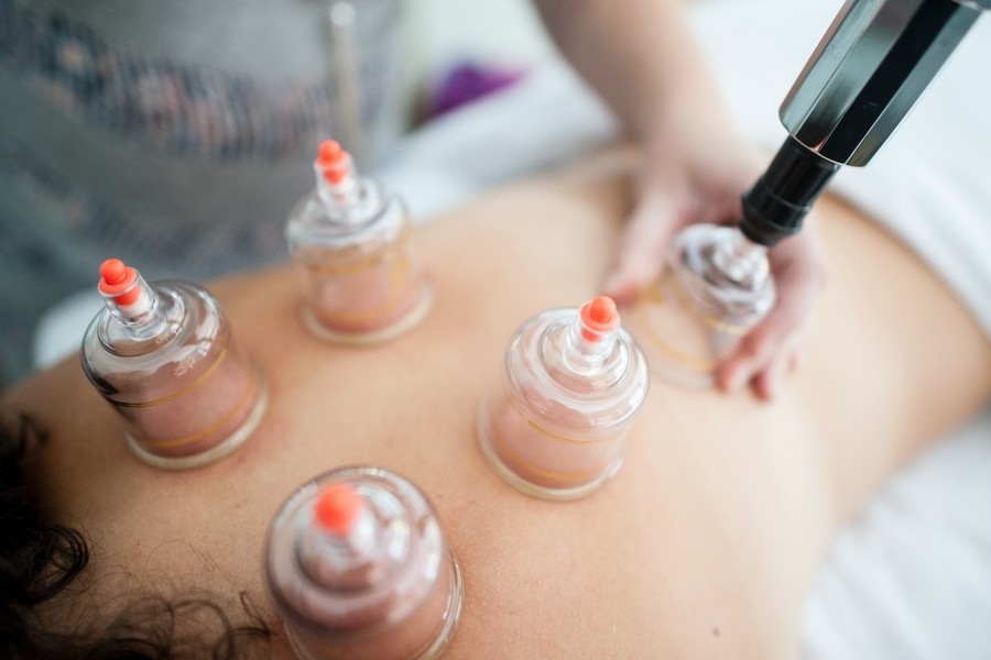 Cupping terapija